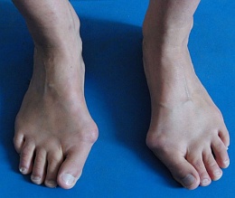 Click image for larger version

Name:	Hallux%20Vallux%20bilateral%20.jpg
Views:	1208
Size:	53.7 KB
ID:	163771